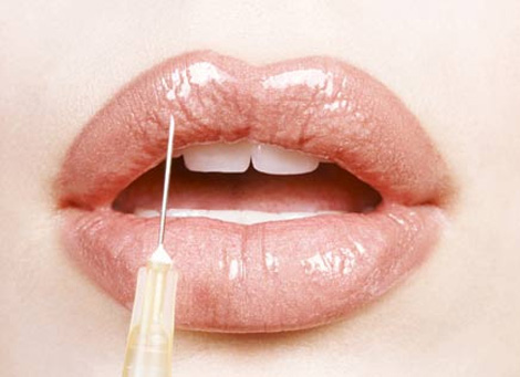 Juvederm ultra smile